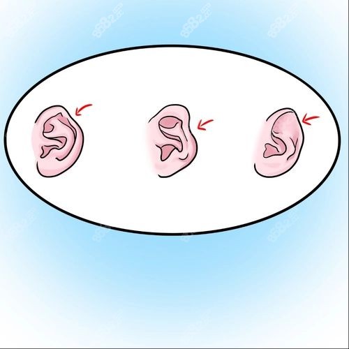 新生儿耳廓畸形类型-耳轮畸形m.8682.cc.jpg
