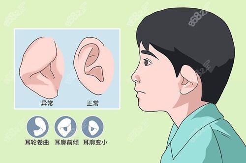 宝宝耳廓畸形-杯状耳图片www.8682.cc.jpg