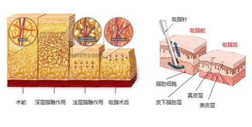 南京裴旭芳吸脂好不好？