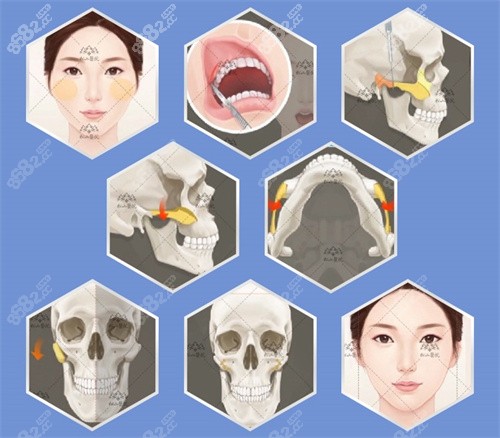 重庆松山医院朱乐林下颌角+颧骨手术技术特色