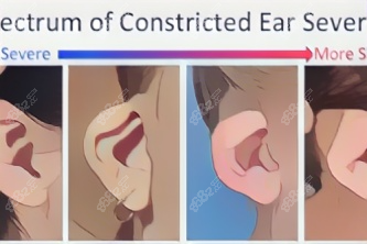宝宝耳廓畸形种类-环缩耳图片.jpg