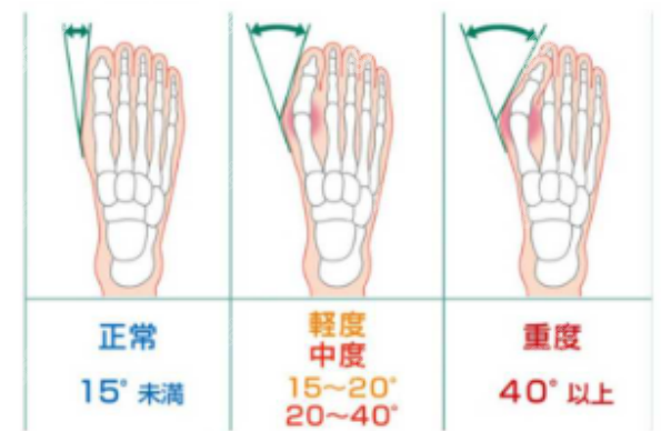 5G微孔弧拇指外翻