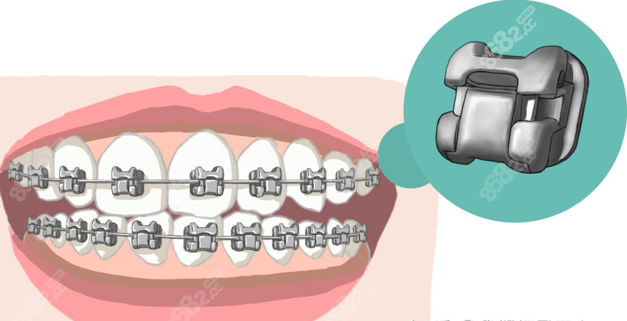 郑州德韩口腔金属牙套www.8682.cc