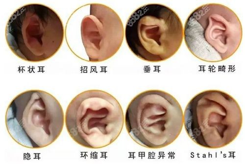 8种耳廓畸形图片.jpg