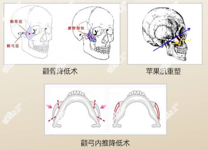 颧骨内推手术图示8682.cc