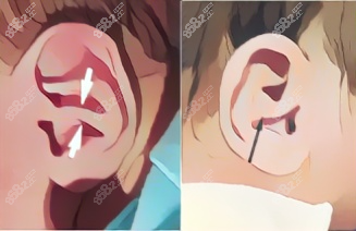 小孩耳廓畸形-Conchal Crus耳图片.jpg