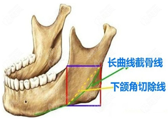 长曲线下颌角截骨