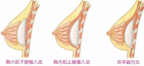 隆胸植入层次