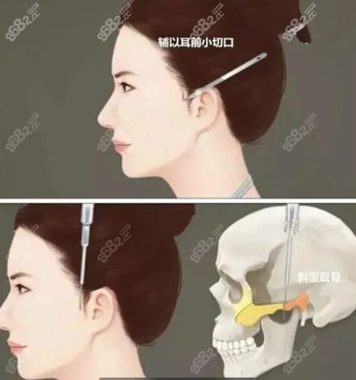 上海华美李志海医生轮颧骨整形技术优势