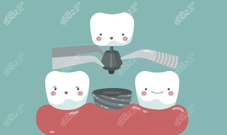 广州曙光医院种植牙怎么样