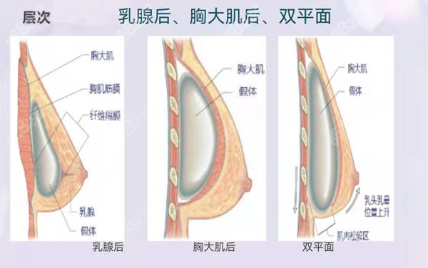 隆胸层次