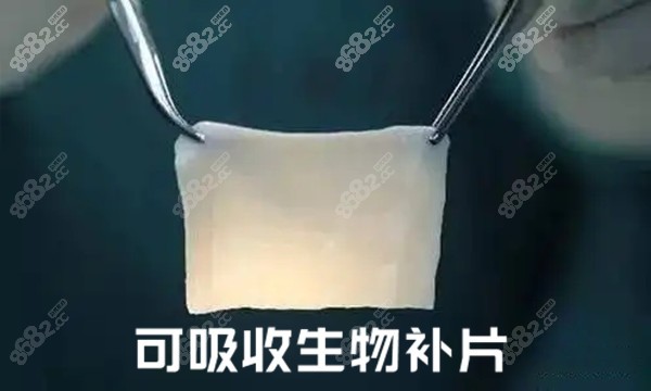 下巴注射奥美定取出后可用生物补片修复