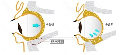 韩国必当归整形医院柳济圣矫正突眼技术牛