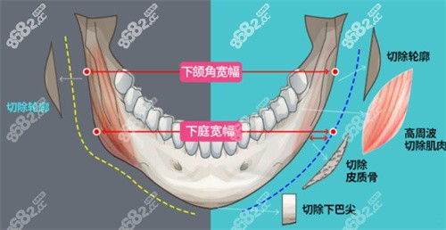 重庆松山医院下颌角整形哪位医生技术好？