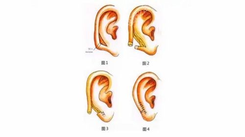 儿童耳朵畸形-隐耳图片.jpg