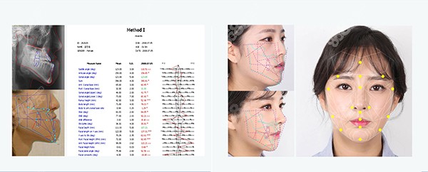 李秀真院长JSRO双鄂手术