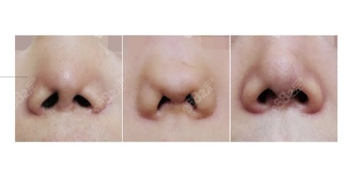 韩国格瑞丝噢爱美整形医院鼻孔矫正对比照
