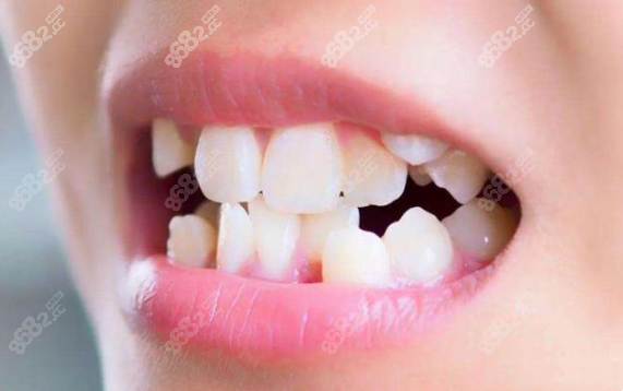 牙齿畸形www.8682.cc
