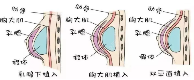 假体隆胸手术