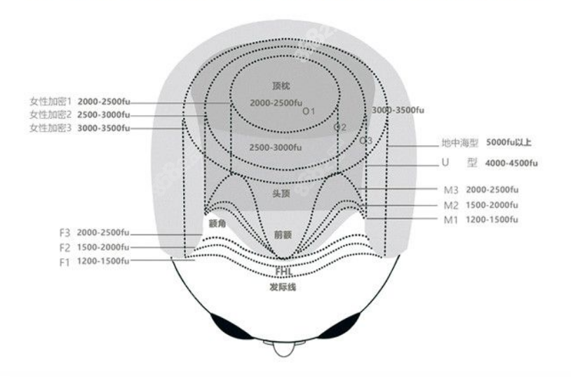 植发分级标准图