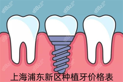 上海浦东新区种植牙价格表