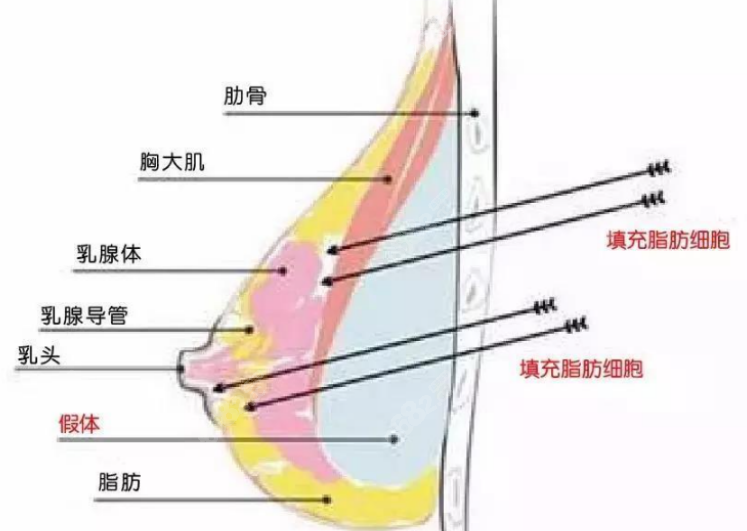 假体隆胸手术