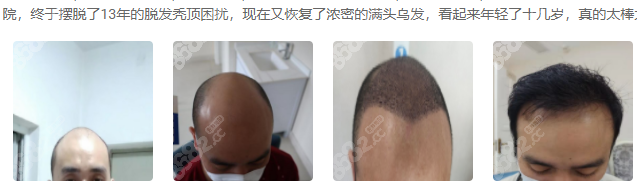 春草植发医院口碑