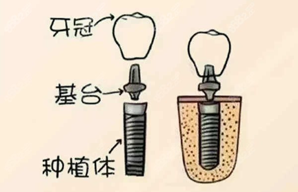 保定种植牙多少钱一颗