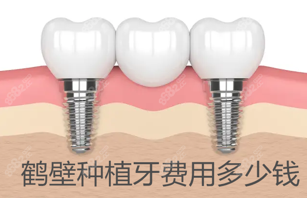 鶴壁種植牙費用多少錢