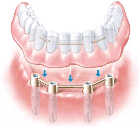 鶴壁半口種植牙
