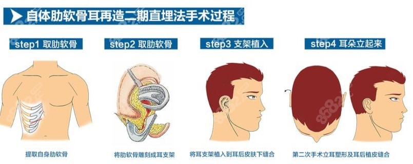 <!--<i data=20240705-sp></i>-->小耳再造技术水平高8682网