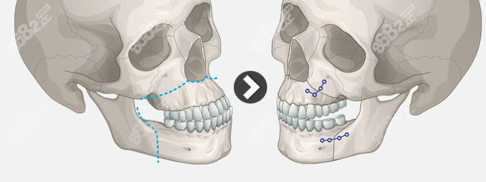 泰国骨性地包天双颌正颌手术过程和步骤图片8682.cc