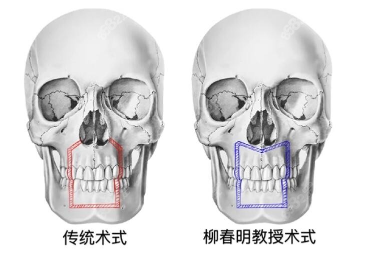 柳春明正颌实例技术好m.8682.cc