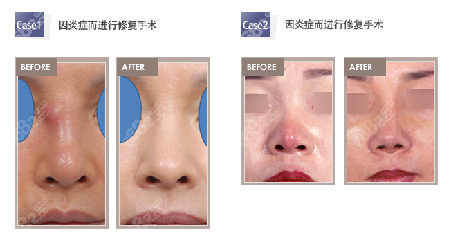 膨体隆鼻炎症进行修复手术实例