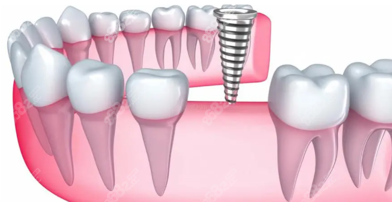 上海美奥口腔种植牙