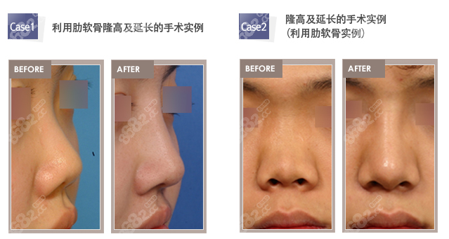 <!--<i data=20240705-sp></i>-->隆鼻实例照片