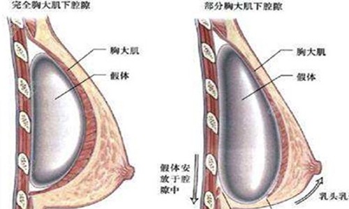 杭州时光隆胸