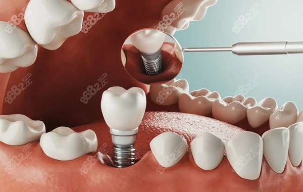 2023成都口腔医院种植牙价格优惠详情