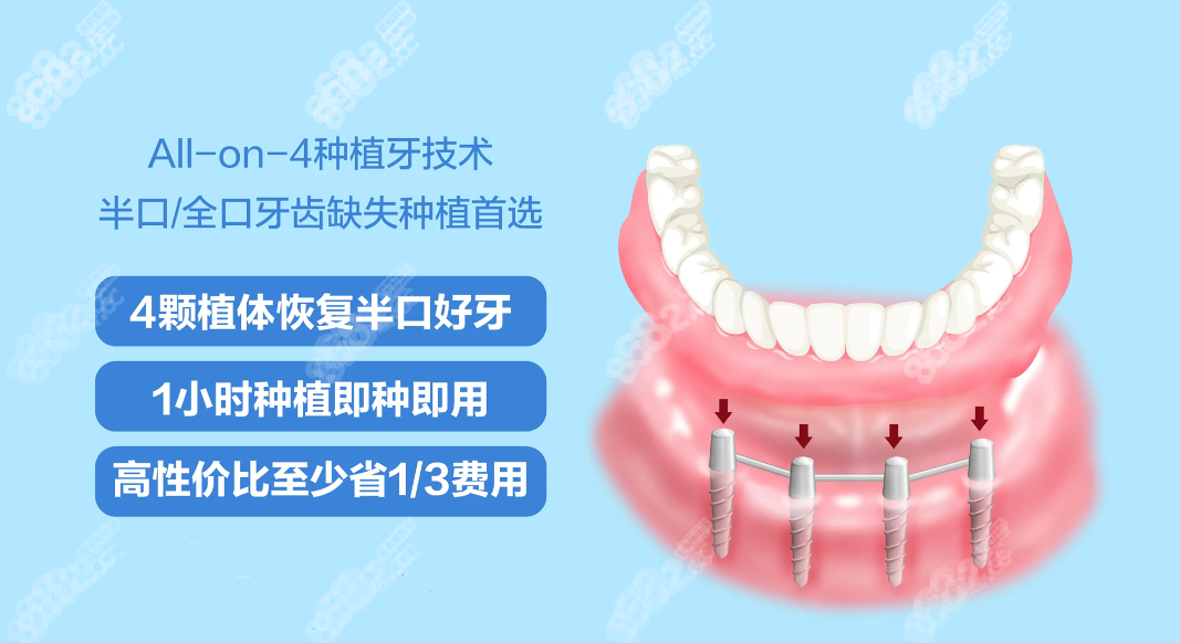 抚顺all-on-4满口种植牙价格8682cc