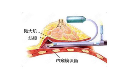 杭州时光隆胸