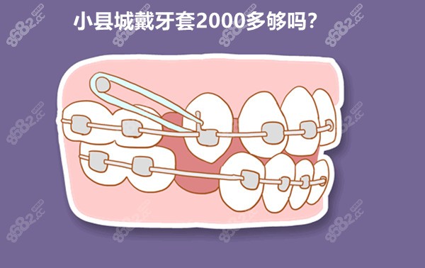 小县城戴牙套2000多够吗？