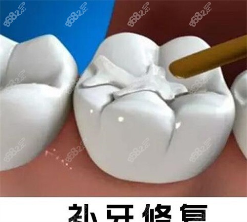 北京煤炭医院补牙修复
