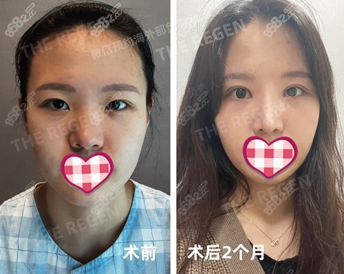 韓國(guó)JN整形外科對(duì)比示例