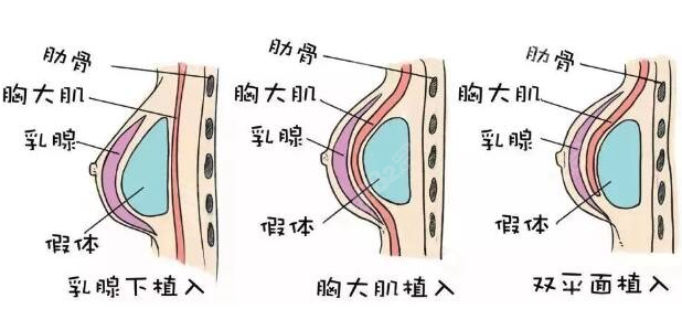 广东韩妃假体隆胸怎么样