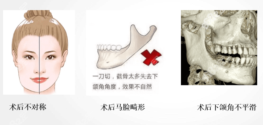 韩国欧佩拉整形外科3D打印补骨修复好