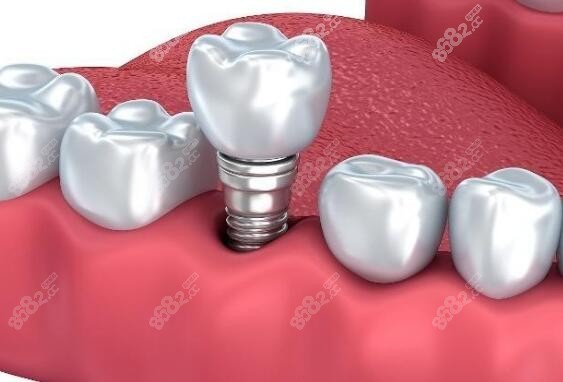 永州安牙舒口腔医院种植牙技术怎么样