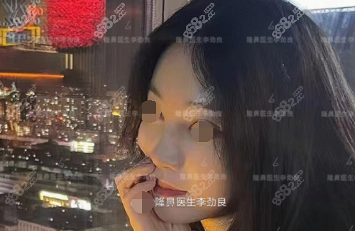 李劲良医生鼻子术后