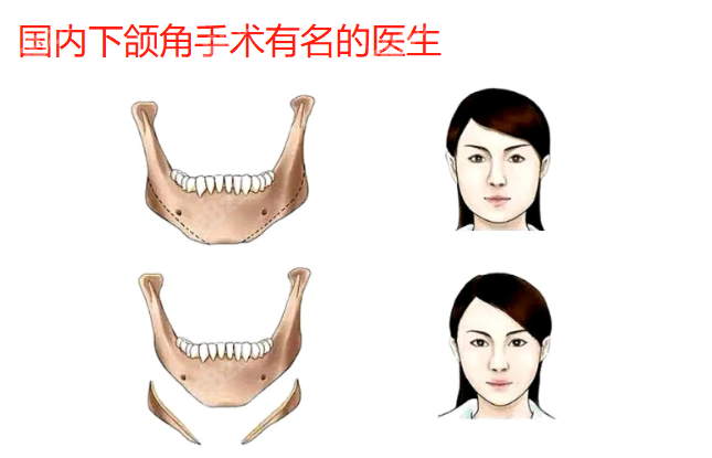 国内下颌角手术有名的医生