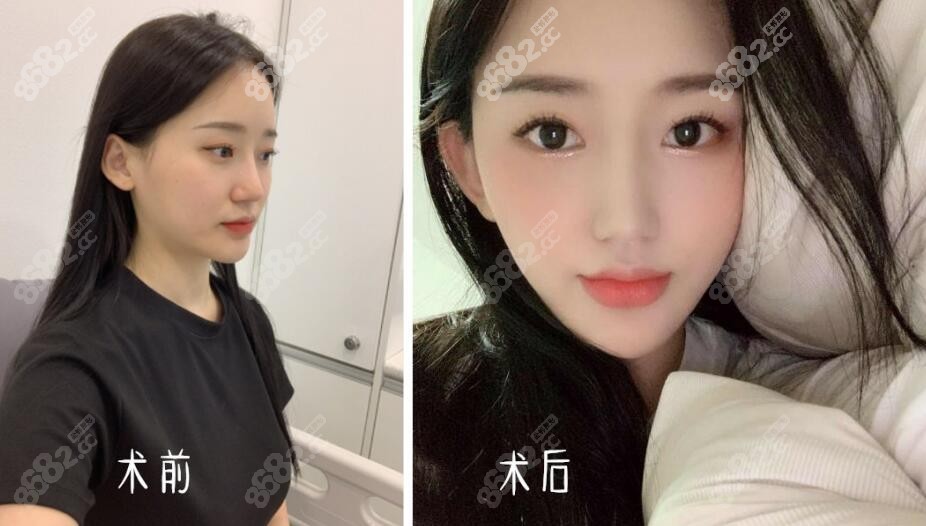mesh假体隆鼻后比较自然
