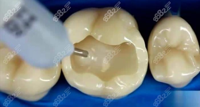 厦门登特口腔补牙多少钱一颗